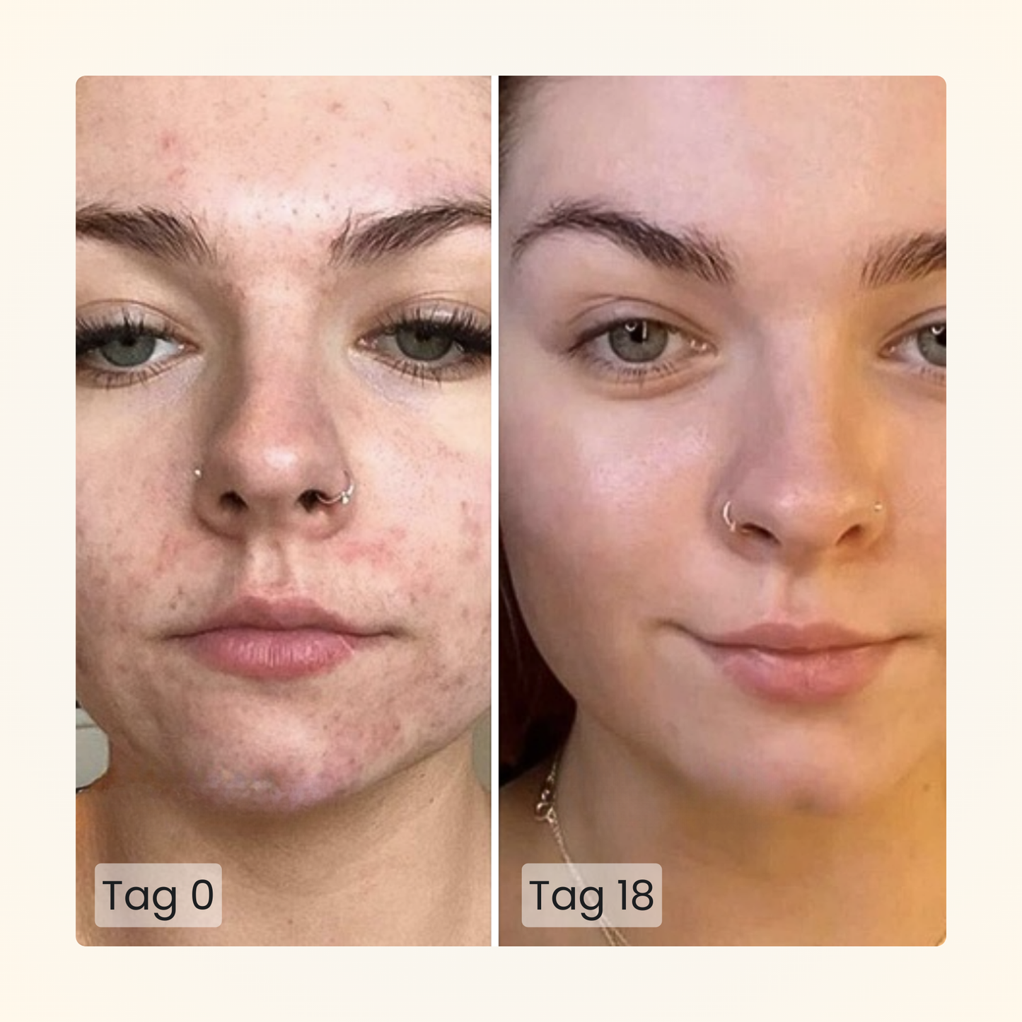 Gloomi® Skin Essence Bar (pakke med 2) + Rutinesæt