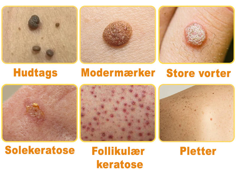 SkinPure™ – Spray til Urenheder & Vorter