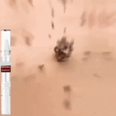 DermaVrij™ Serumpen | Fjern vorter og leverpletter smertefrit på 5 dage!