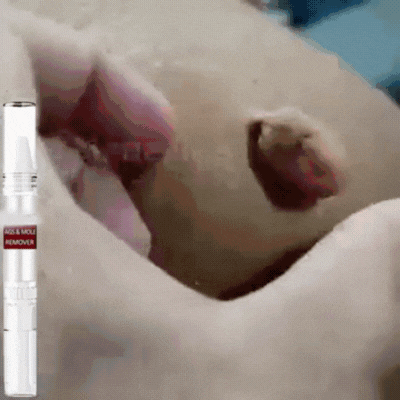 DermaVrij™ Serumpen | Fjern vorter og leverpletter smertefrit på 5 dage!