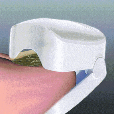 LumiNail™ - Slip af med tykke, misfarvede negle én gang for alle!