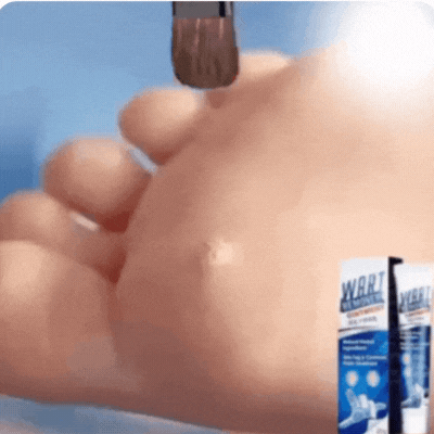 Wratvrij™ Vortefjerner - Fjern alle dine vorter smertefrit på kun 7 dage!