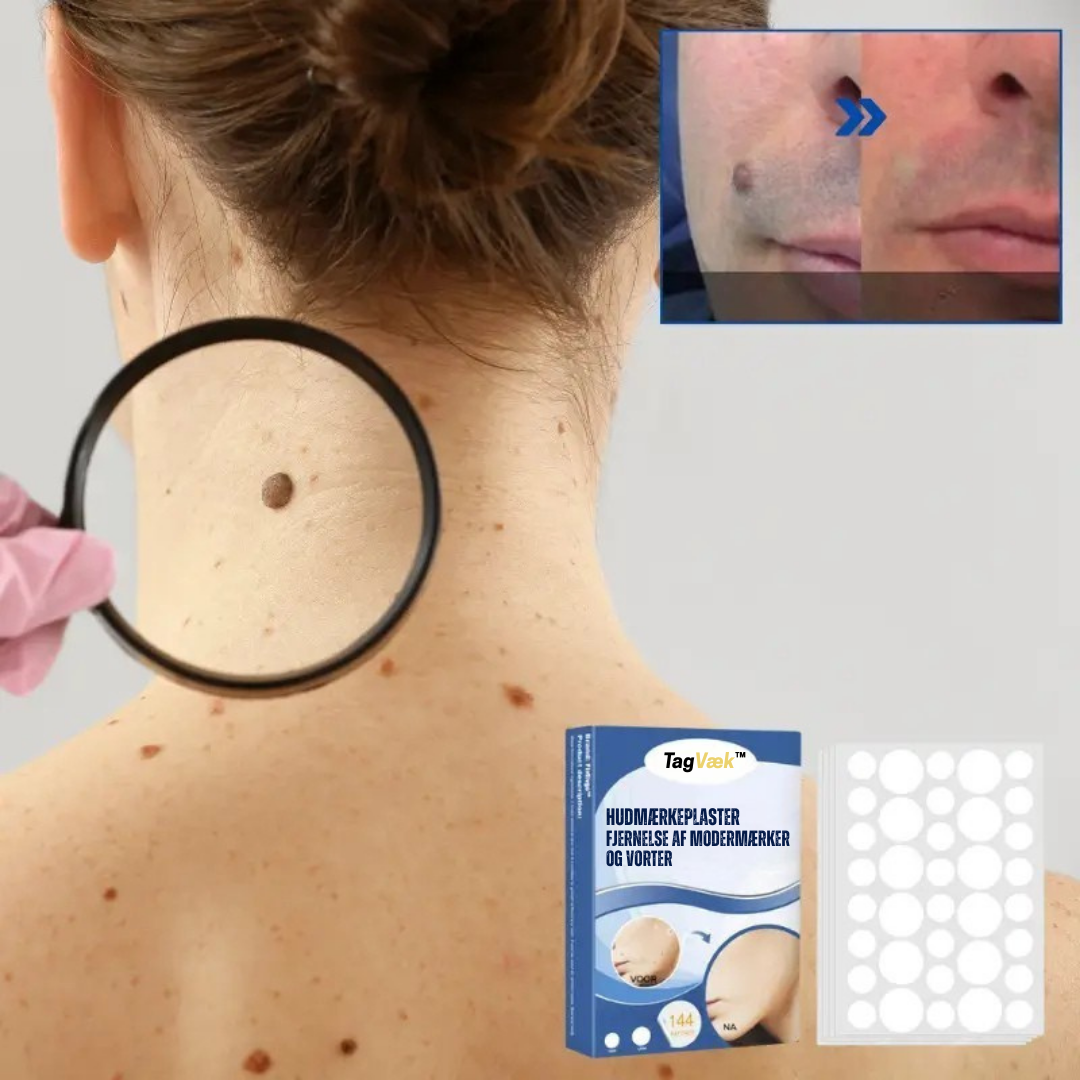 TagVæk™ – Fjern hudmærker på kun 5 dage