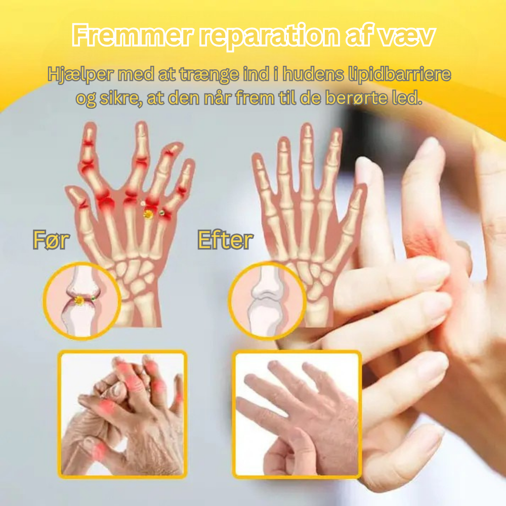 TLOPA® Botulinumtoksin og bigift Smertecreme til knogleheling