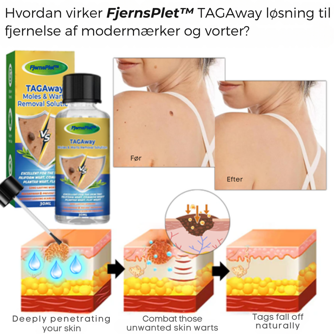 FjernsPlet™ – Effektiv behandling på 7 dage