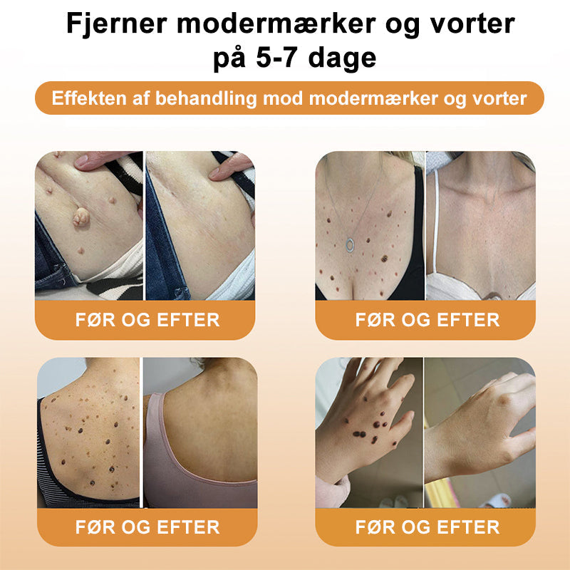 SkinPure™ – Spray til Urenheder & Vorter