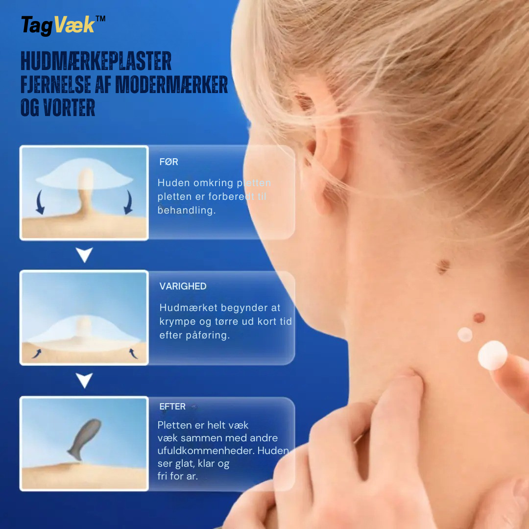 TagVæk™ – Fjern hudmærker på kun 5 dage