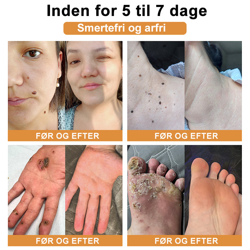 SkinPure™ – Spray til Urenheder & Vorter