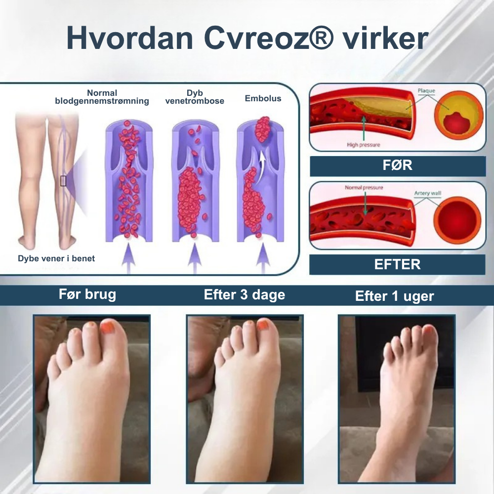 Cvreoz® – Afgiftende urtecreme med sort kommen