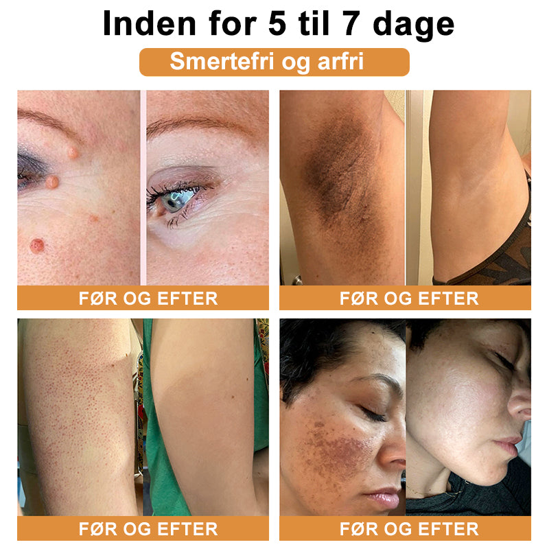 SkinPure™ – Spray til Urenheder & Vorter
