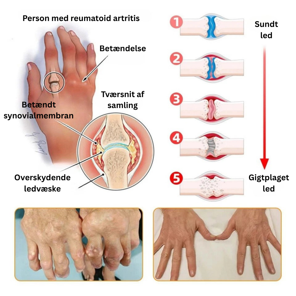 TLOPA® Botulinumtoksin og bigift Smertecreme til knogleheling