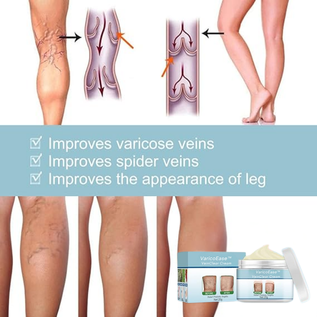 VaricoEase™ - VeinClear Cream - Reducerer synligt åreknuder og hjælper dig med at få glatte, sunde ben på bare 7 dage! (1+1 GRATIS)