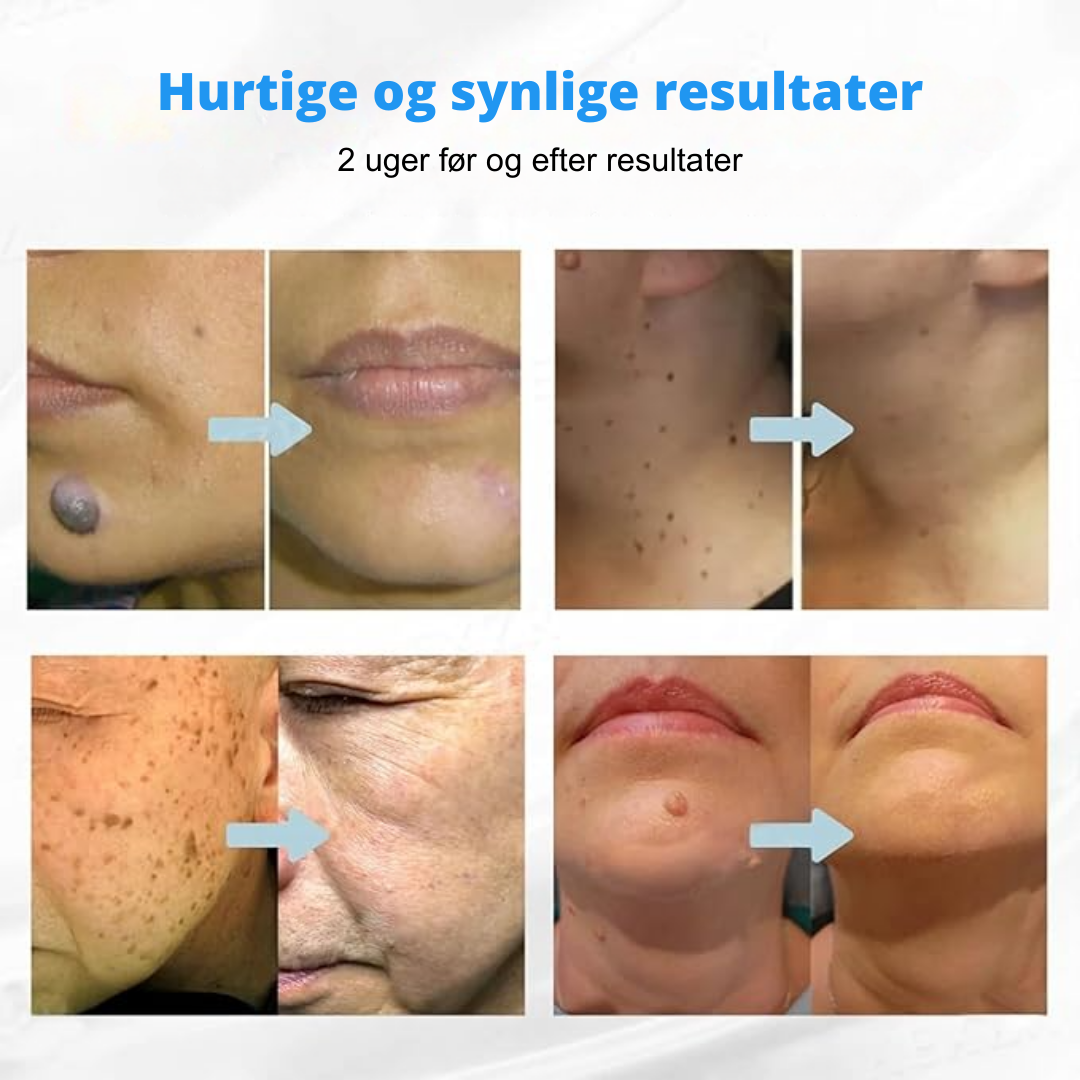 Hidone™ Ikke-invasiv laserpen til fjernelse af modermærker og vorter