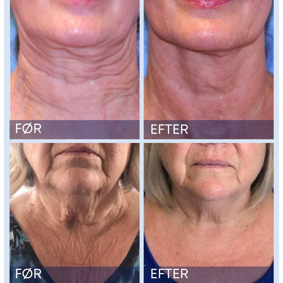 Furzero UngdomsBoost Elixer™ | Forynger din hud og giver et øjeblikkeligt løft