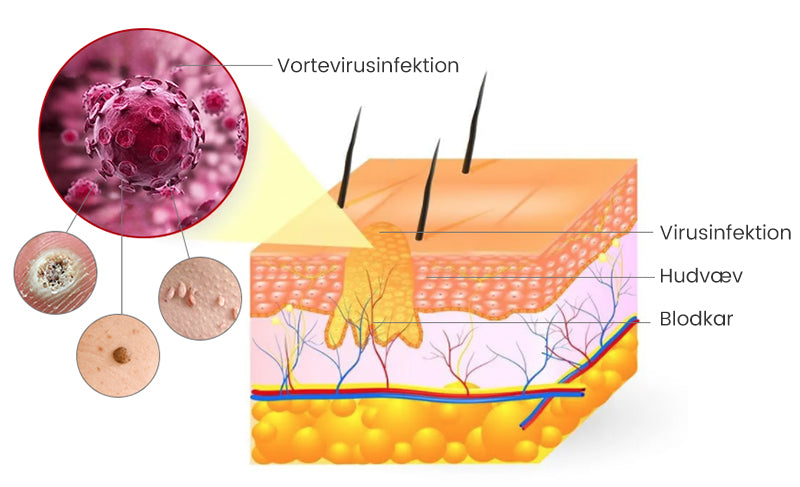 SkinPure™ – Spray til Urenheder & Vorter