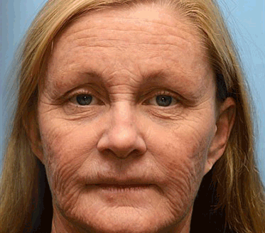 Anti-Rynke™ Botox Bee Venom Wrinkle Removal Cream