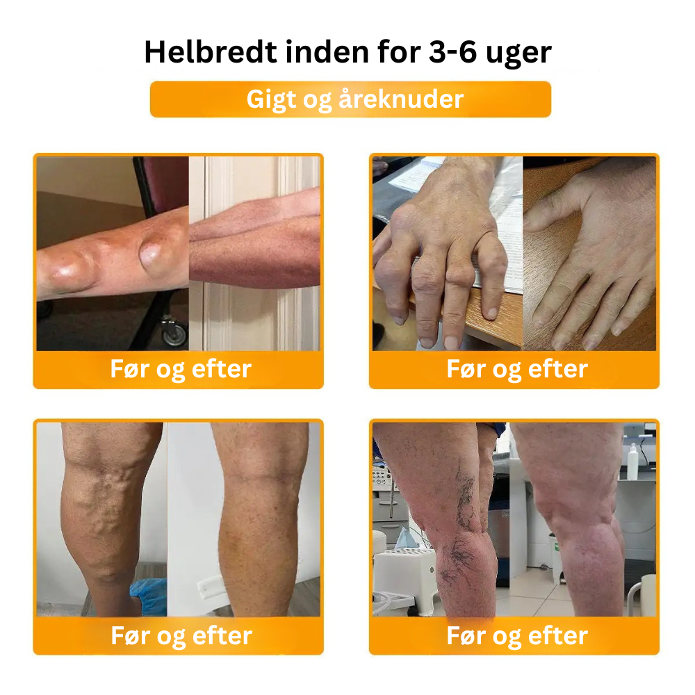 TLOPA® Botulinumtoksin og bigift Smertecreme til knogleheling