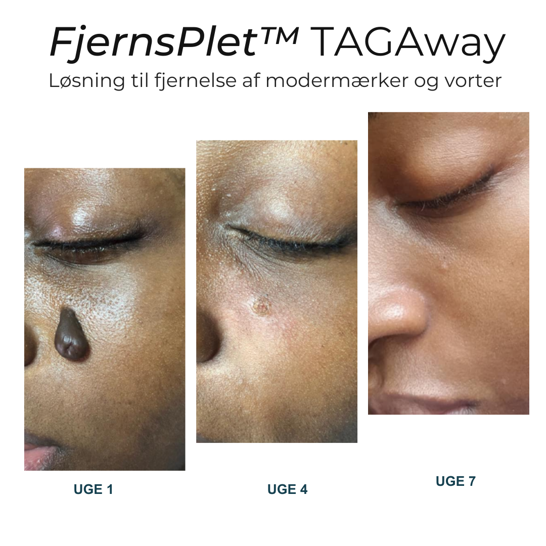 FjernsPlet™ – Effektiv behandling på 7 dage