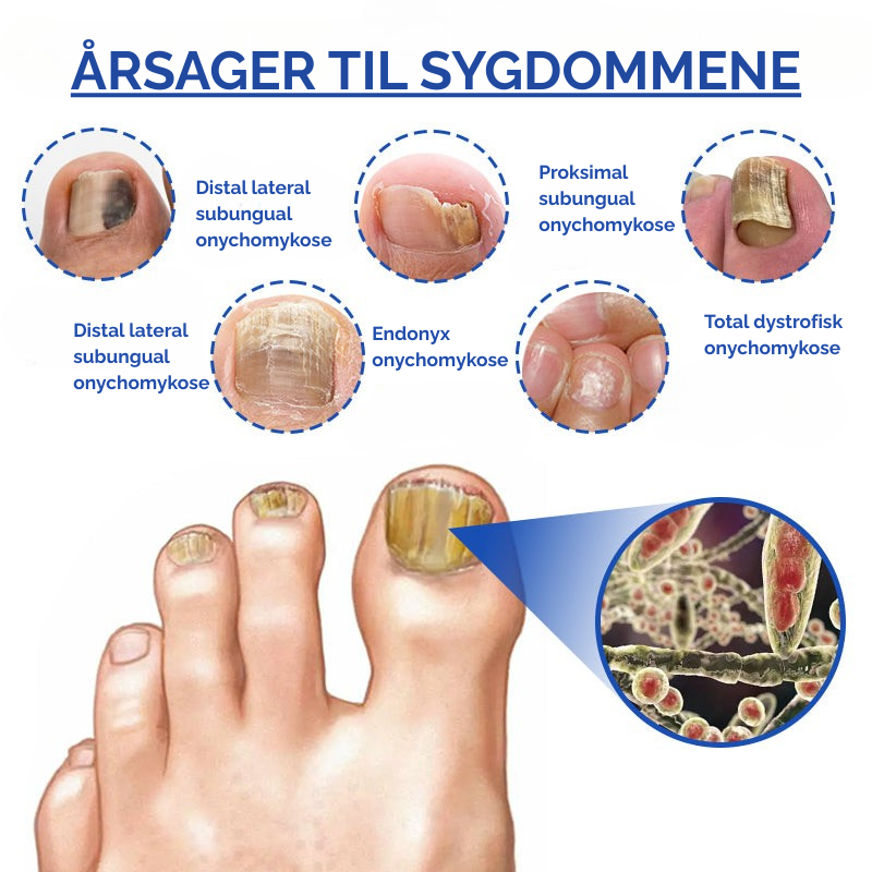 MycoLight™ Skånsom behandling mod neglesvamp