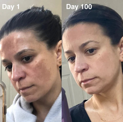 Fivfivgo™ TripleAction Vitamin C Freckle Removal Cream