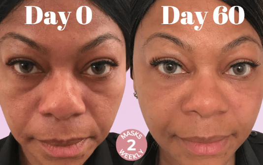 LøftLine™ – 3D Opstrammende Smilelinje-Maske