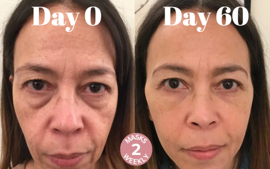 LøftLine™ – 3D Opstrammende Smilelinje-Maske