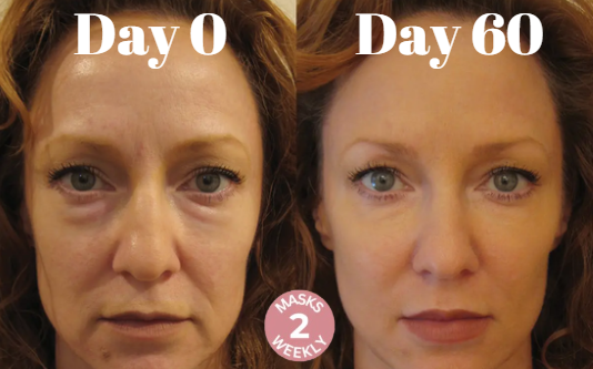 LøftLine™ – 3D Opstrammende Smilelinje-Maske