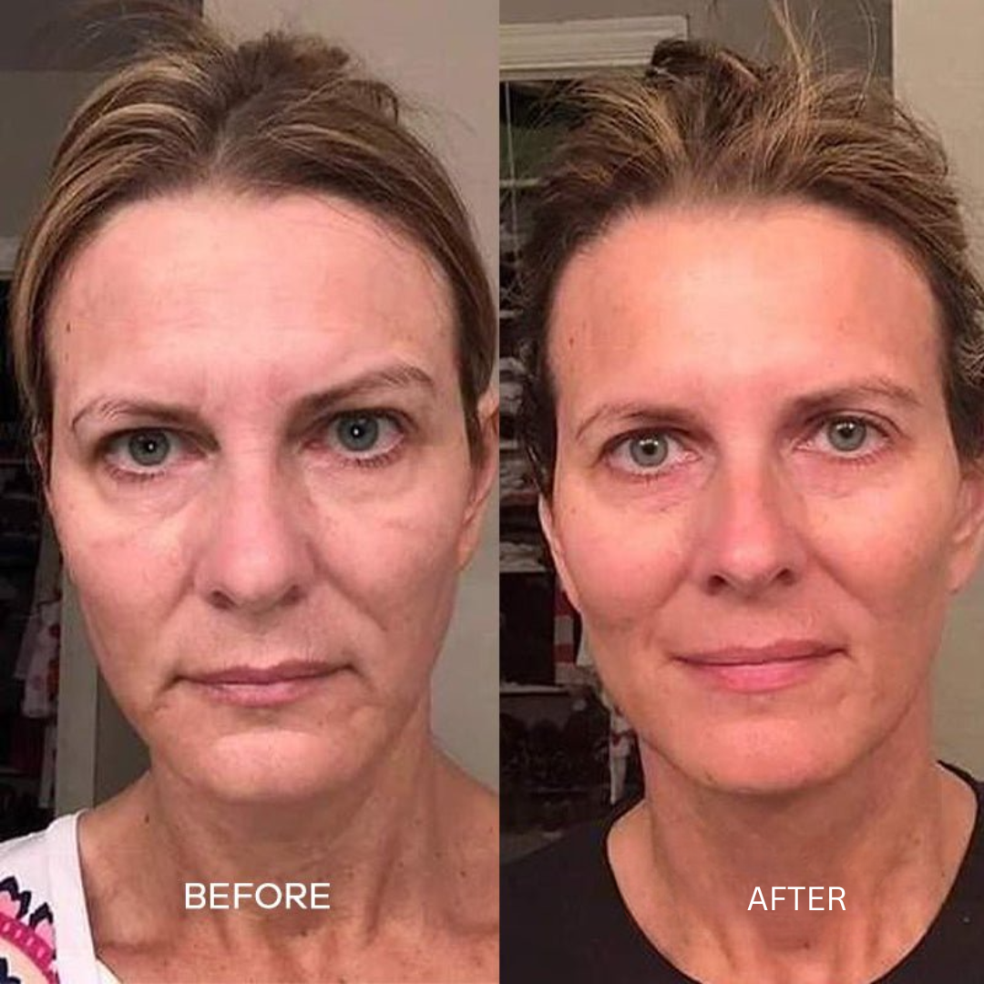 YOOLI™ Microneedle Infusion | Slip af med rynker på 3 uger