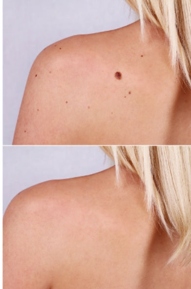 Wratvrij™ Vortefjerner - Fjern alle dine vorter smertefrit på kun 7 dage!