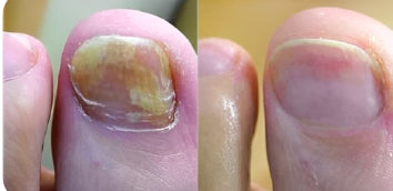 NegleShield™ Stick