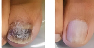 NegleShield™ Stick