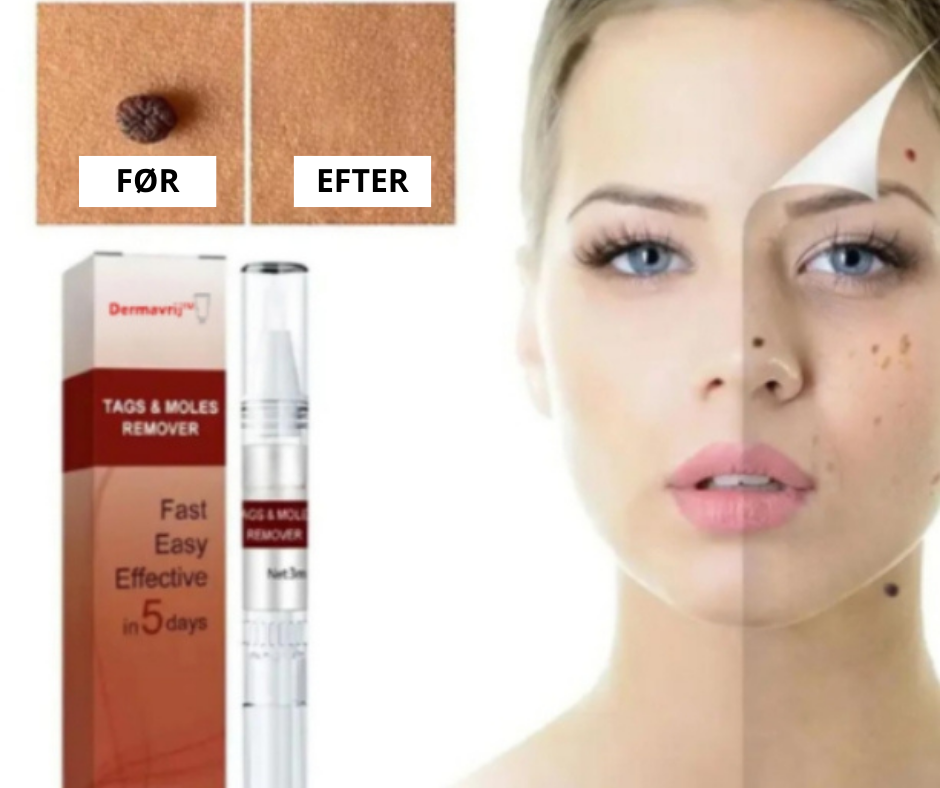 DermaVrij™ Serumpen | Fjern vorter og leverpletter smertefrit på 5 dage!