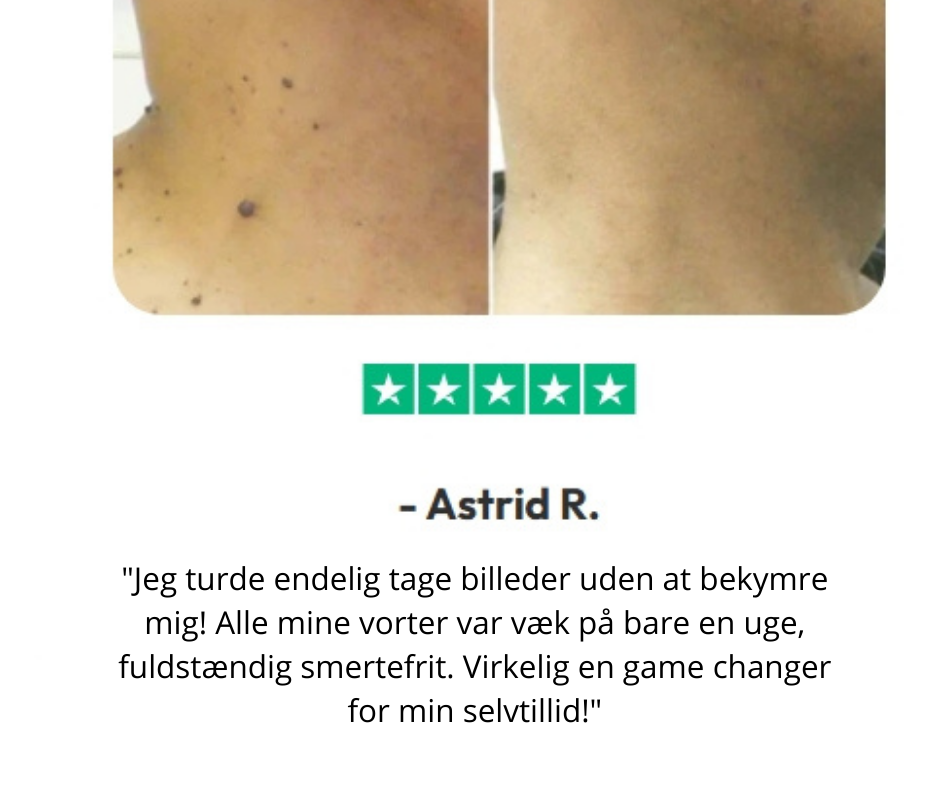 DermaVrij™ Serumpen | Fjern vorter og leverpletter smertefrit på 5 dage!