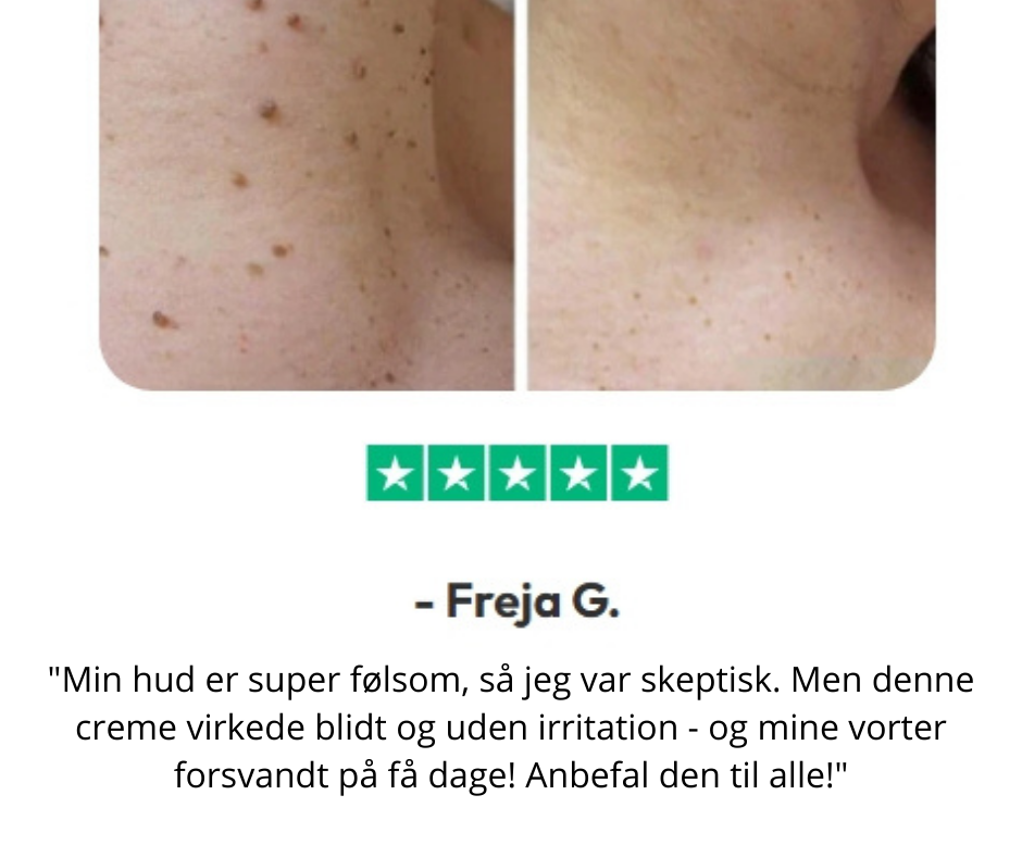 DermaVrij™ Serumpen | Fjern vorter og leverpletter smertefrit på 5 dage!