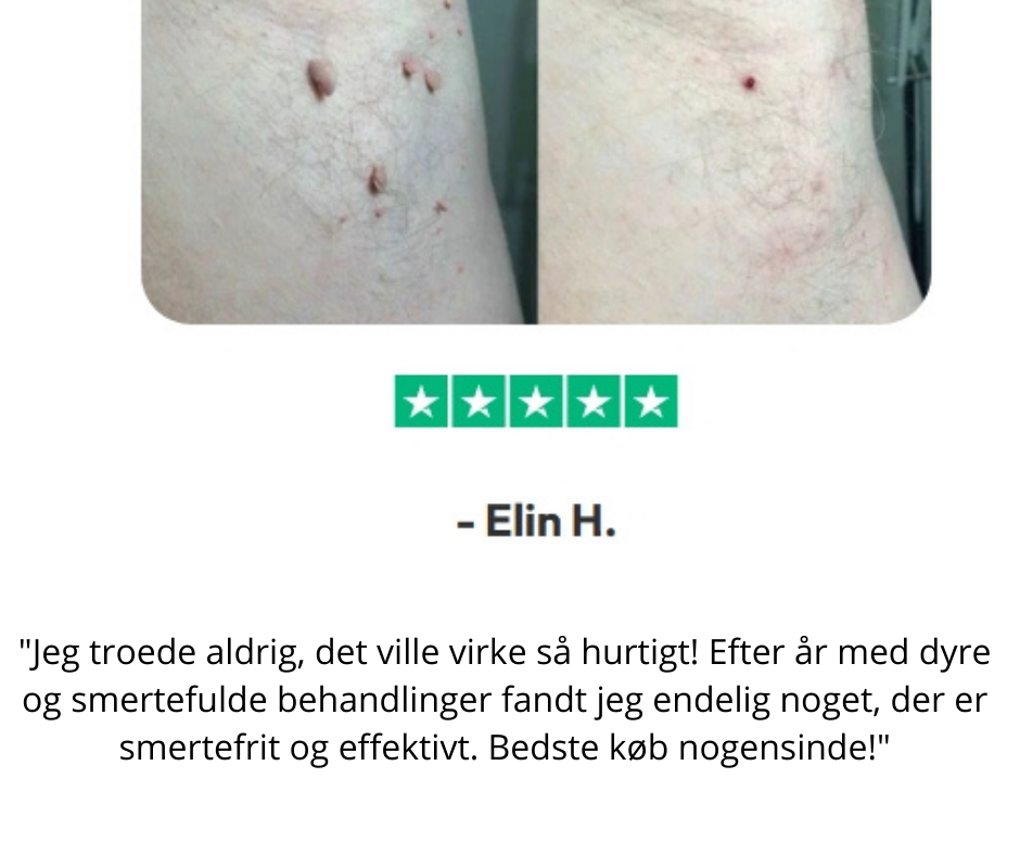 DermaVrij™ Serumpen | Fjern vorter og leverpletter smertefrit på 5 dage!