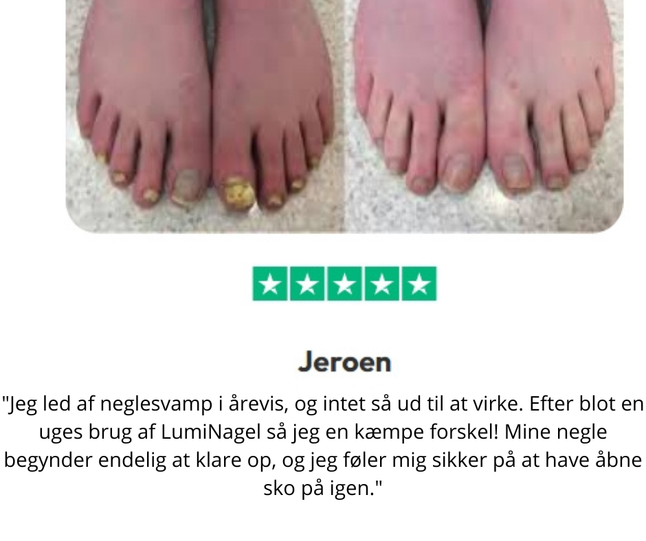 LumiNail™ - Slip af med tykke, misfarvede negle én gang for alle!