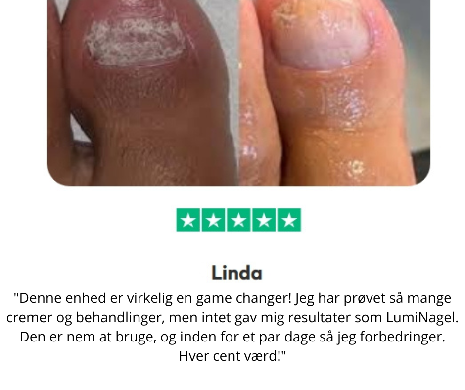 LumiNail™ - Slip af med tykke, misfarvede negle én gang for alle!