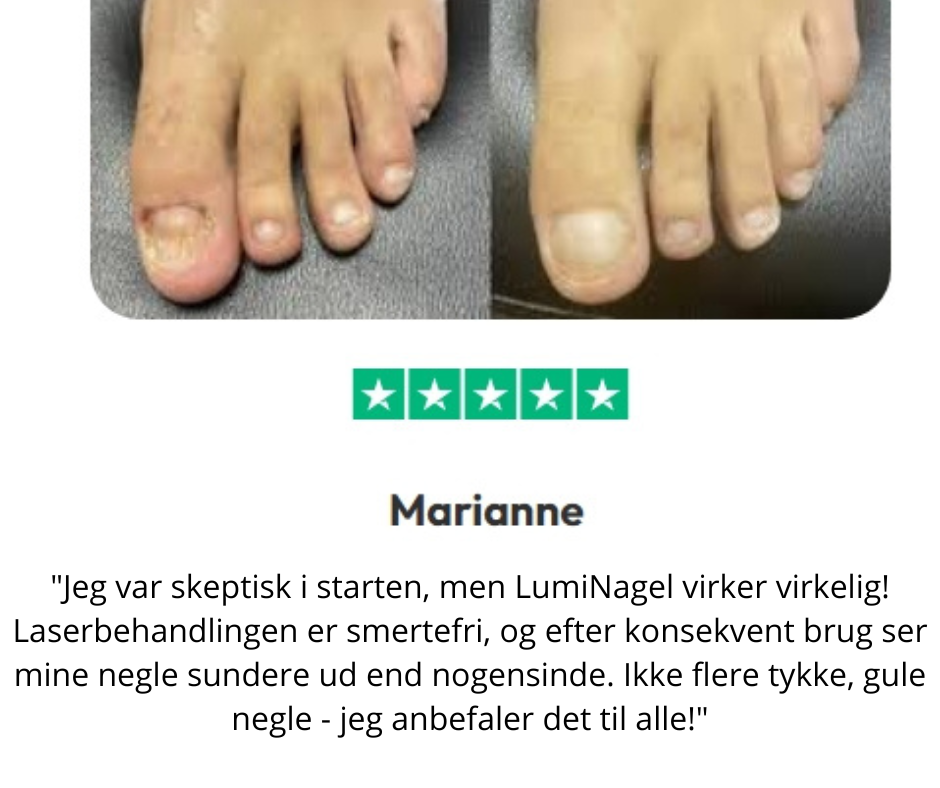LumiNail™ - Slip af med tykke, misfarvede negle én gang for alle!