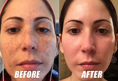 Fivfivgo™ TripleAction Vitamin C Freckle Removal Cream