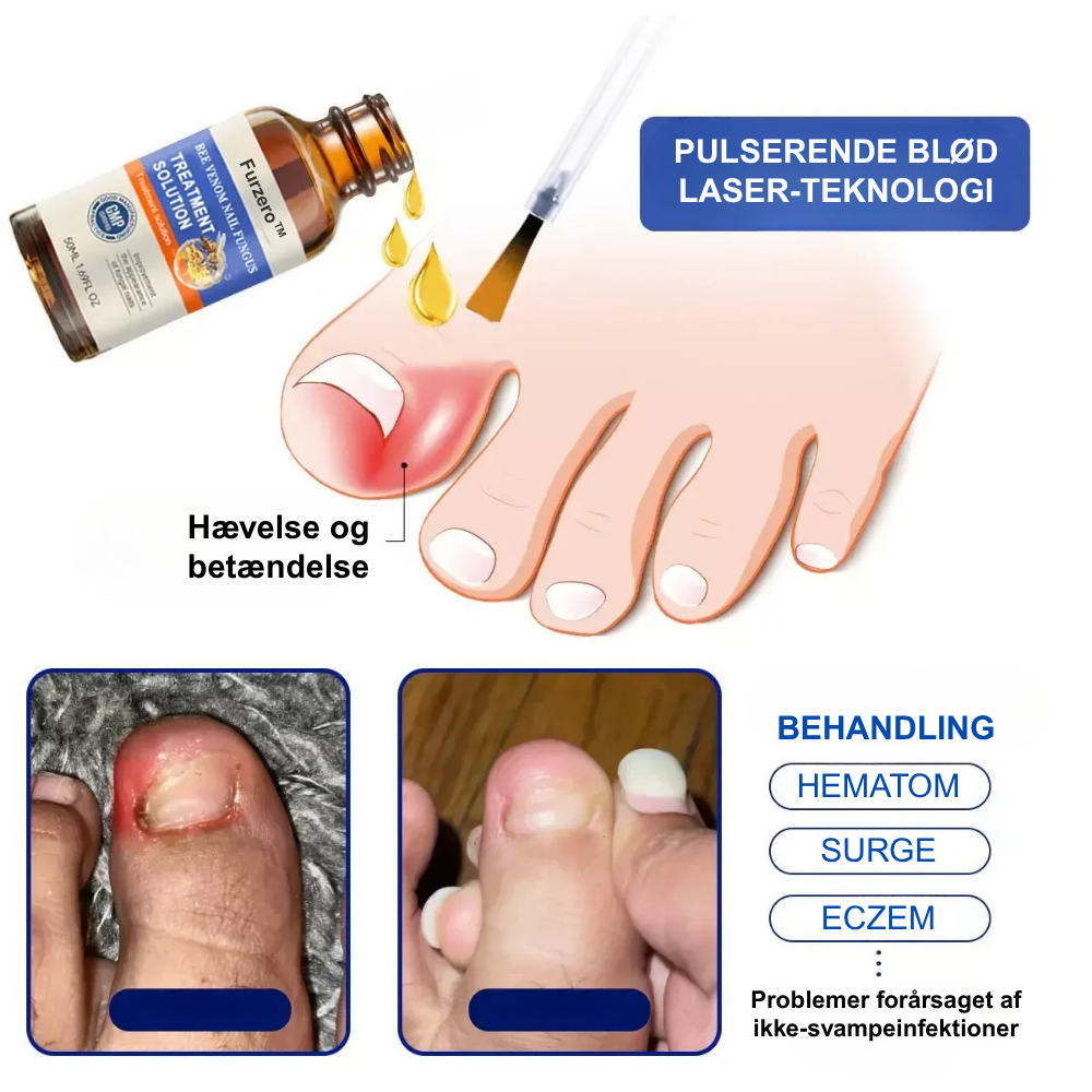 Furzero™ En komplet løsning på problemet med neglesvamp (1+1 GRATIS)