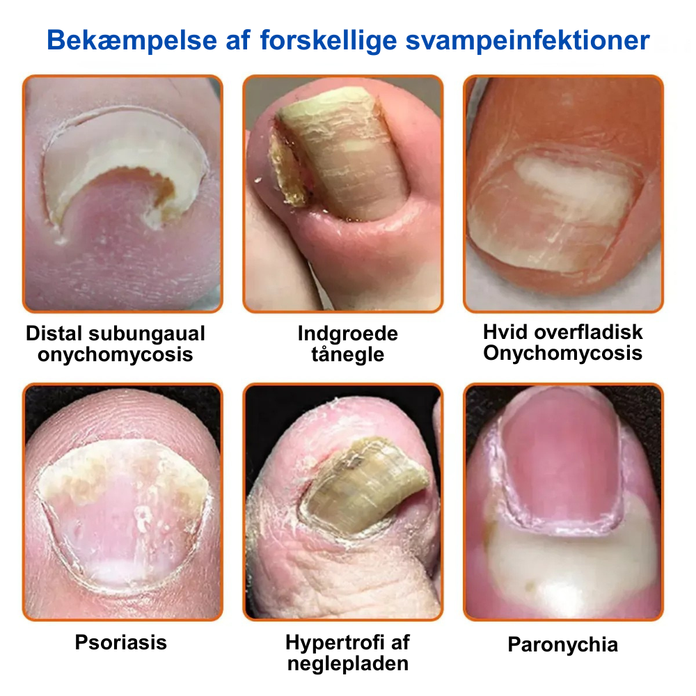 Furzero™ En komplet løsning på problemet med neglesvamp (1+1 GRATIS)