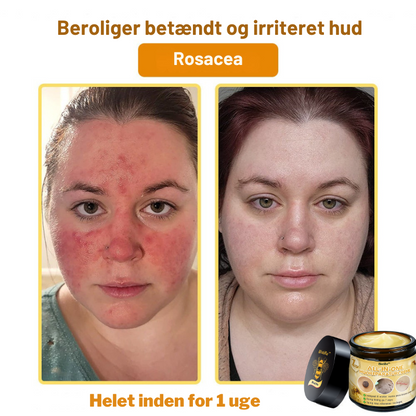 Bistille™ | All-in-One hudreparationscreme mod insektstik og irritation Dermatologisk testet og anbefalet i Danmark ( Anbefalet af DDS)