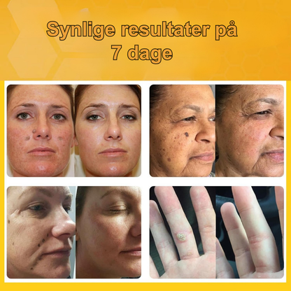 PureStik™ | Farvel til hudmærker og rynker med bi-gift – hjemmefra på få dage!