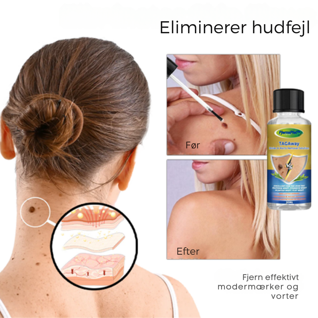 FjernsPlet™ – Effektiv behandling på 7 dage