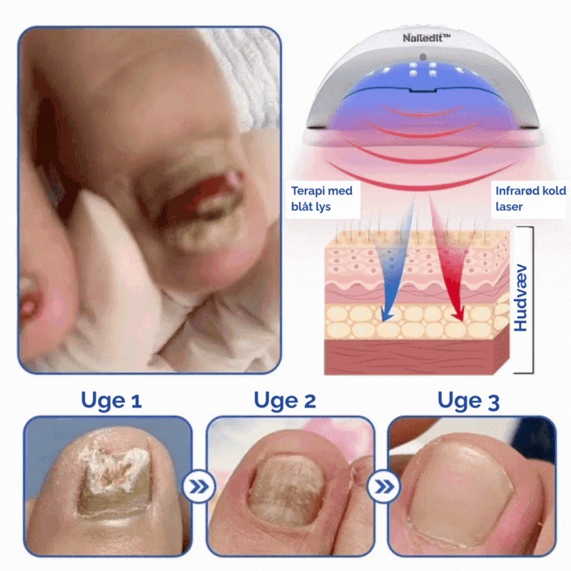 MycoLight™ Skånsom behandling mod neglesvamp