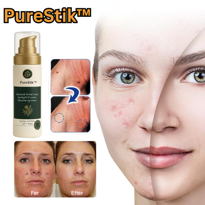 PureStik™ | Farvel til hudmærker og rynker med bi-gift – hjemmefra på få dage!