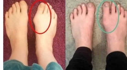 TeoComfort| sig farvel til din hallux valgus