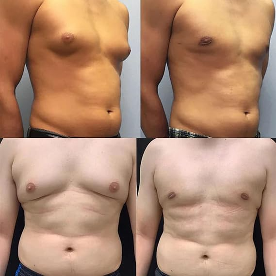 GFOUK™ ThermoFirm Bijengif Gynecomastie Olie (1+1 GRATIS)