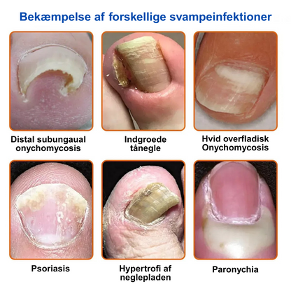 Furzero™ En komplet løsning på problemet med neglesvamp (1+1 GRATIS)